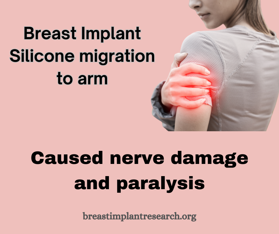 Silicone migration to arm