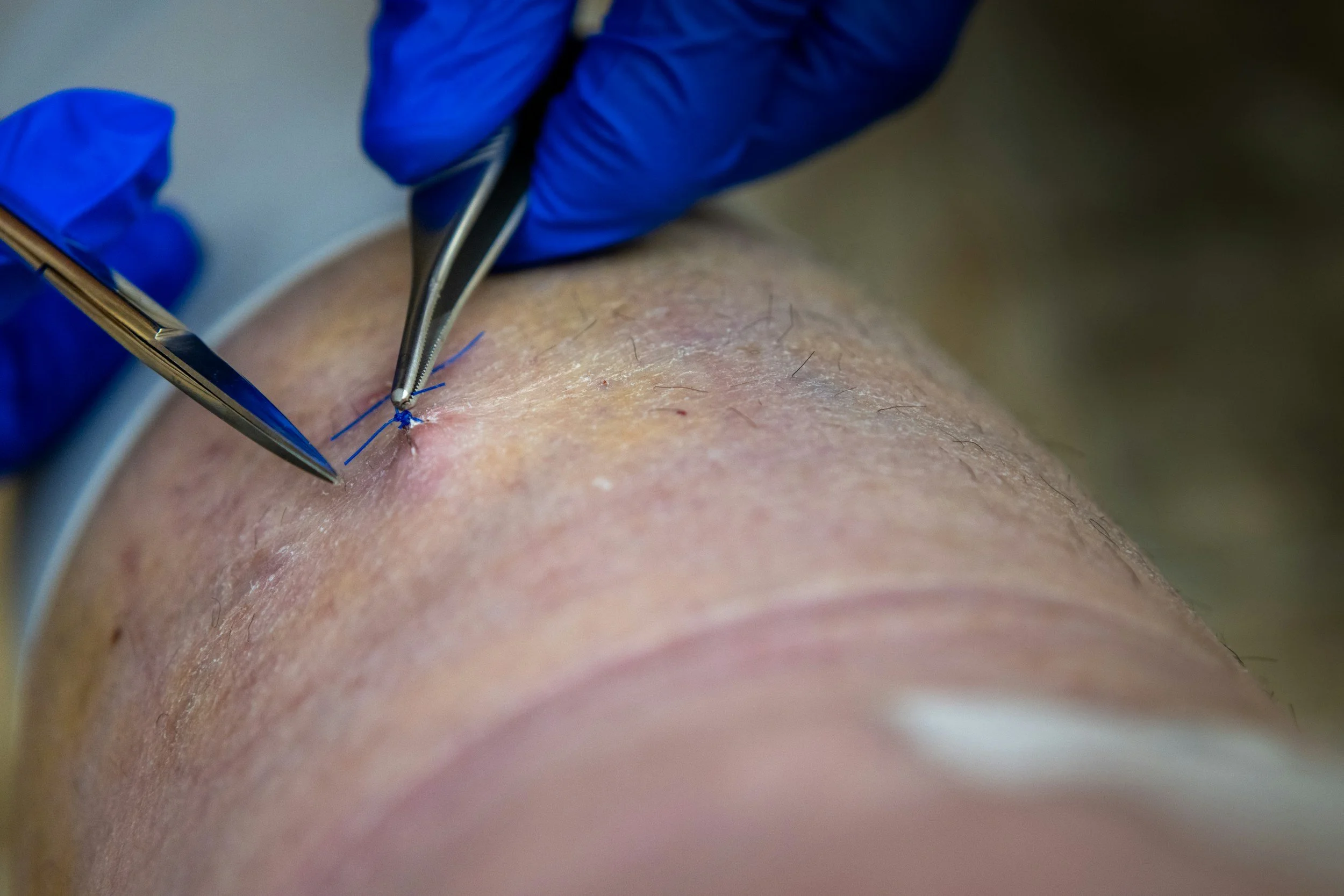 Close-up of a person receiving a medical procedure, with a gloved hand using a surgical tool on the person's skin.