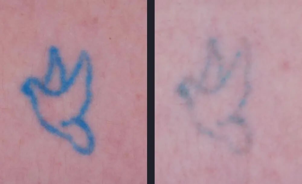 PicoWay Tattoo Removal Before &amp; After 1