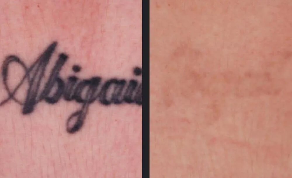 PicoWay Tattoo Removal Before &amp; After 3