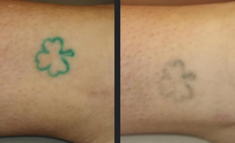 PicoWay Tattoo Removal Before &amp; After 4