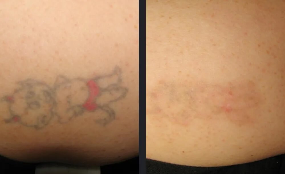 PicoWay Tattoo Removal Before &amp; After 5