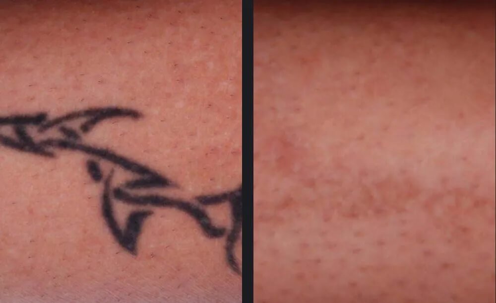 PicoWay Tattoo Removal Before &amp; After 6