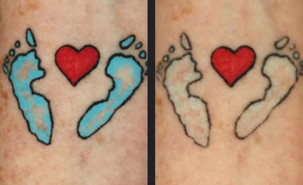 PicoWay Tattoo Removal Before &amp; After 7