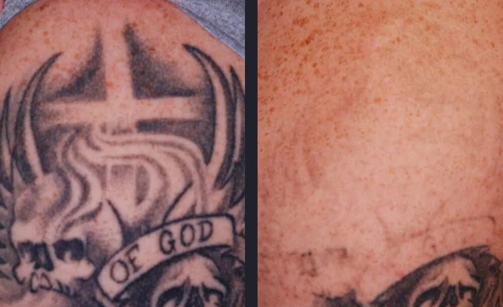PicoWay Tattoo Removal Before &amp; After 8