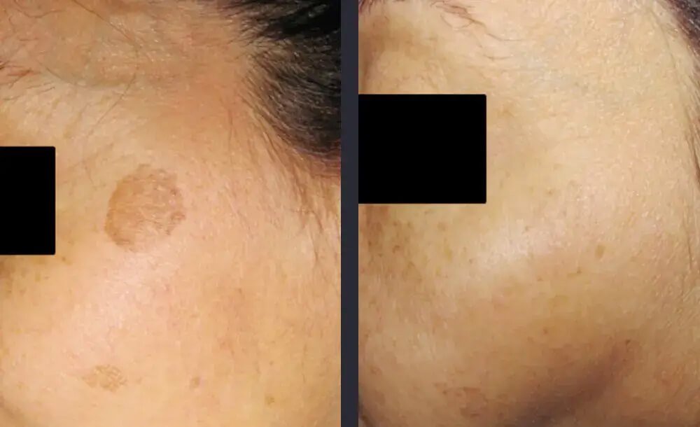 PicoWay Skin Pigmentation Treatment Before &amp; After 2