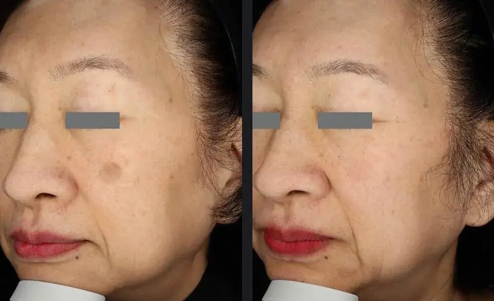 PicoWay Skin Pigmentation Treatment Before &amp; After 1