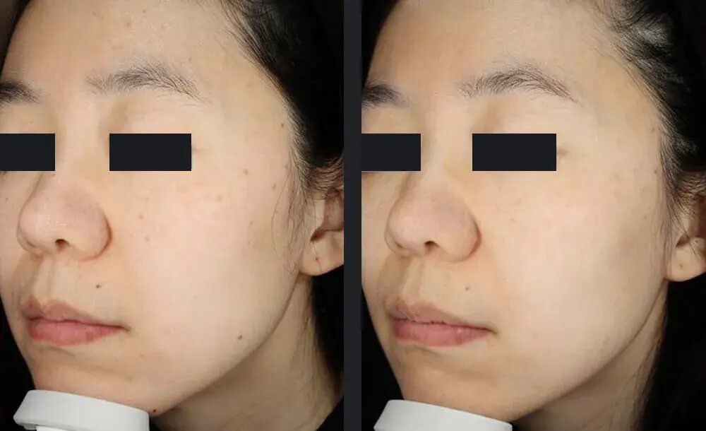 PicoWay Skin Pigmentation Treatment Before &amp; After 3