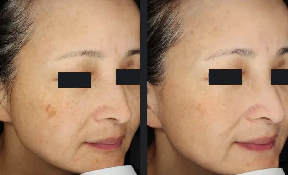 PicoWay Skin Pigmentation Treatment Before &amp; After 4