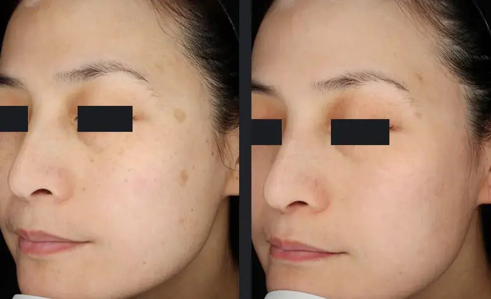PicoWay Skin Pigmentation Treatment Before &amp; After 5