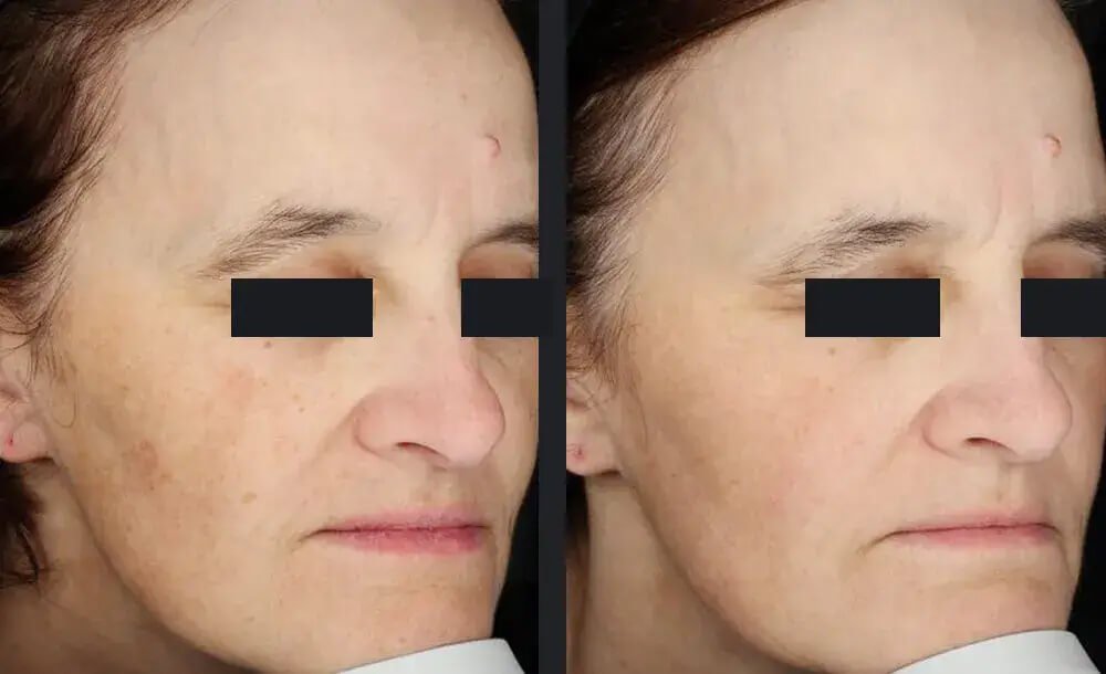PicoWay Skin Pigmentation Treatment Before &amp; After 6