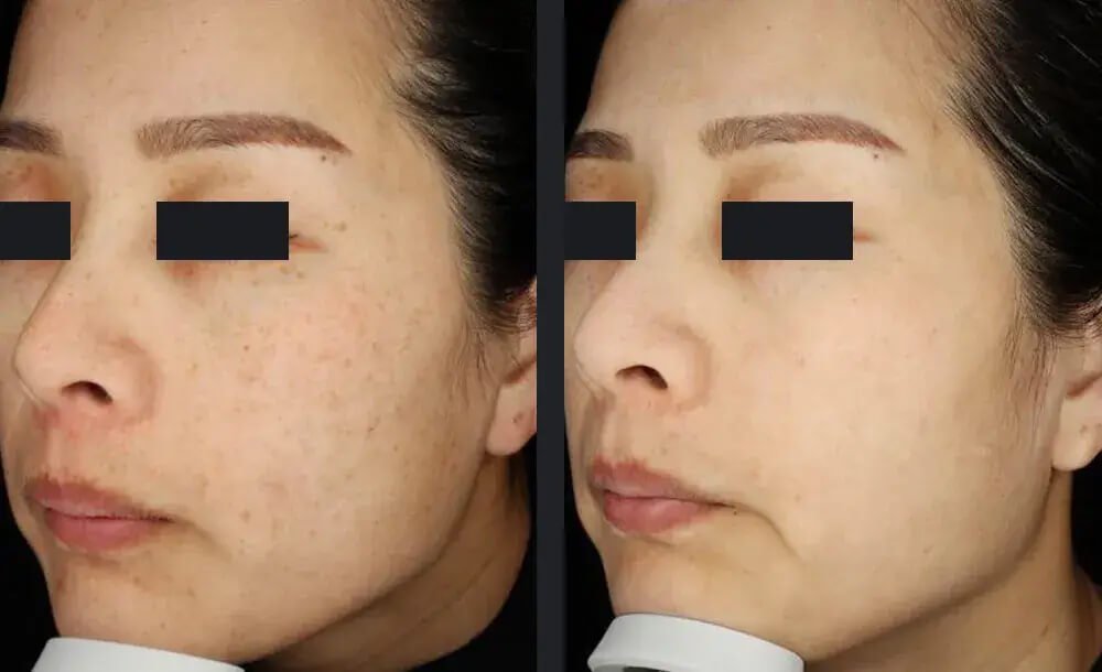 PicoWay Skin Pigmentation Treatment Before &amp; After 7