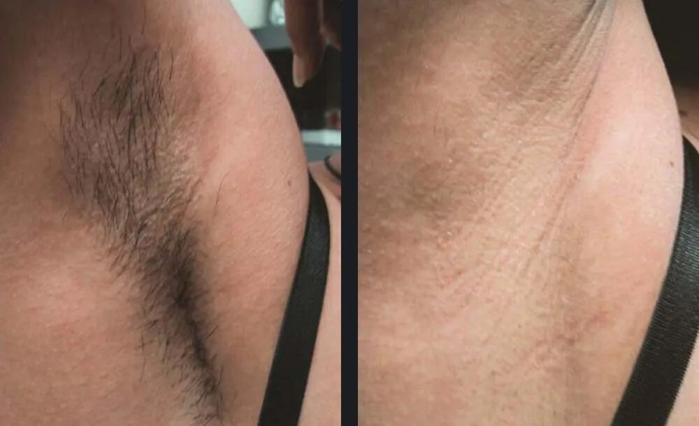 Gentle Body Hair Removal Before &amp; After 1