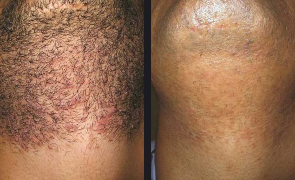 Gentle Body Hair Removal Before &amp; After 2