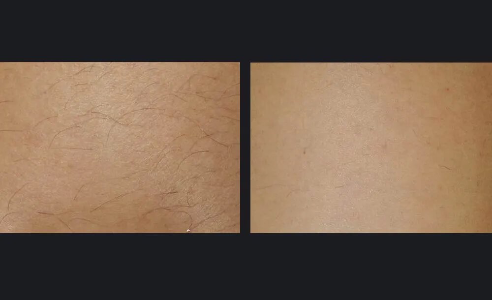 Gentle Body Hair Removal Before &amp; After 5