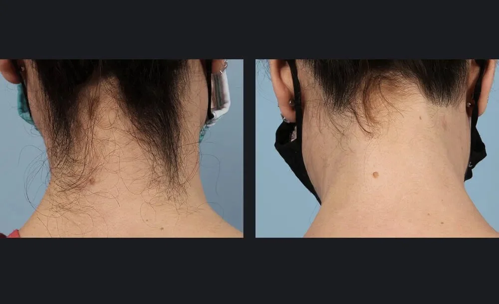 Gentle Body Hair Removal Before & After 4