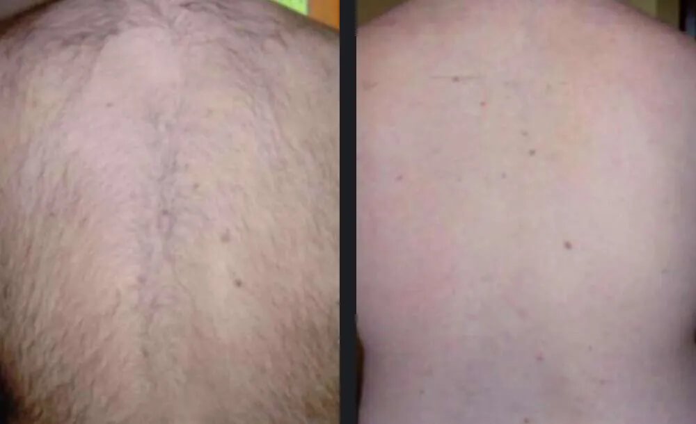 Gentle Body Hair Removal Before &amp; After 6
