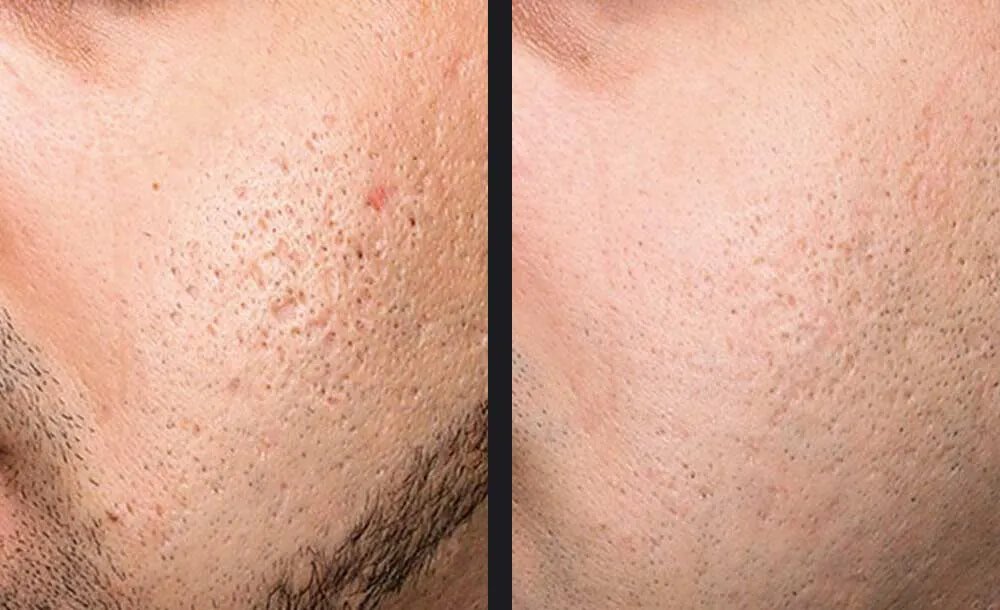 Exceed Microneedling Before &amp; After 1