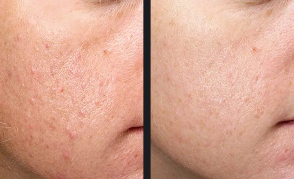Exceed Microneedling Before & After 2