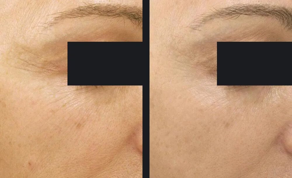 Exceed Microneedling Before &amp; After 3
