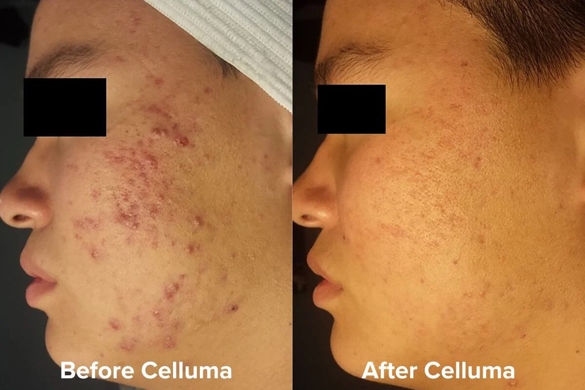 Celluma PRO LED Light Therapy for Acne Before &amp; After