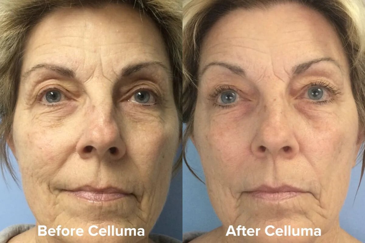 Celluma PRO LED Light Therapy for Wrinkles Before &amp; After
