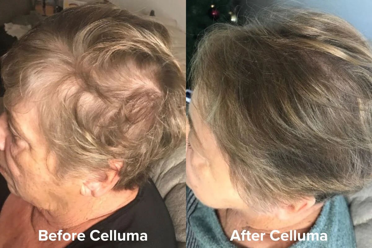 Celluma PRO LED Light Therapy for Hair Loss 1 Before &amp; After