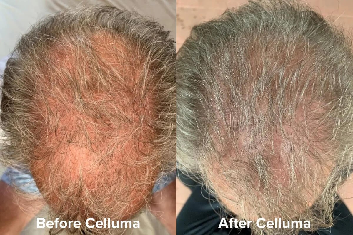 Celluma PRO LED Light Therapy for Hair Loss 2 Before &amp; After