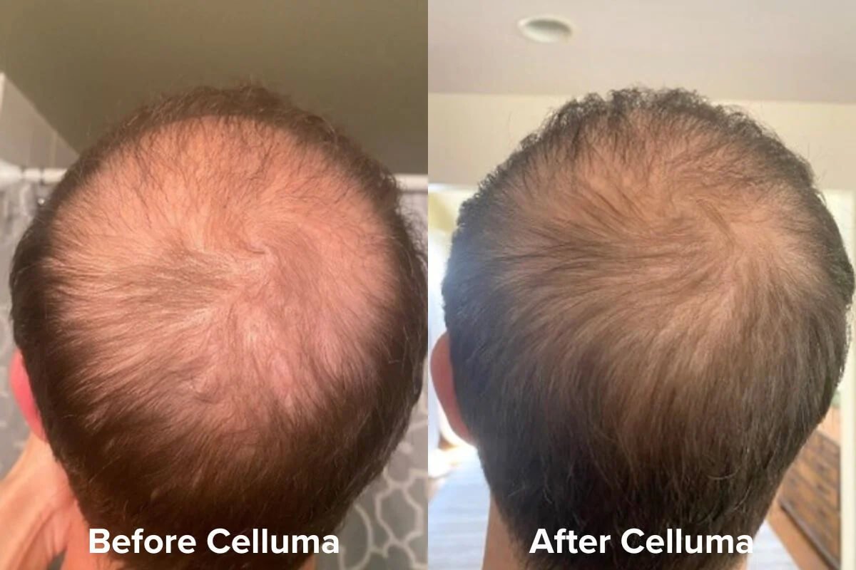 Celluma PRO LED Light Therapy for Hair Loss 3 Before &amp; After