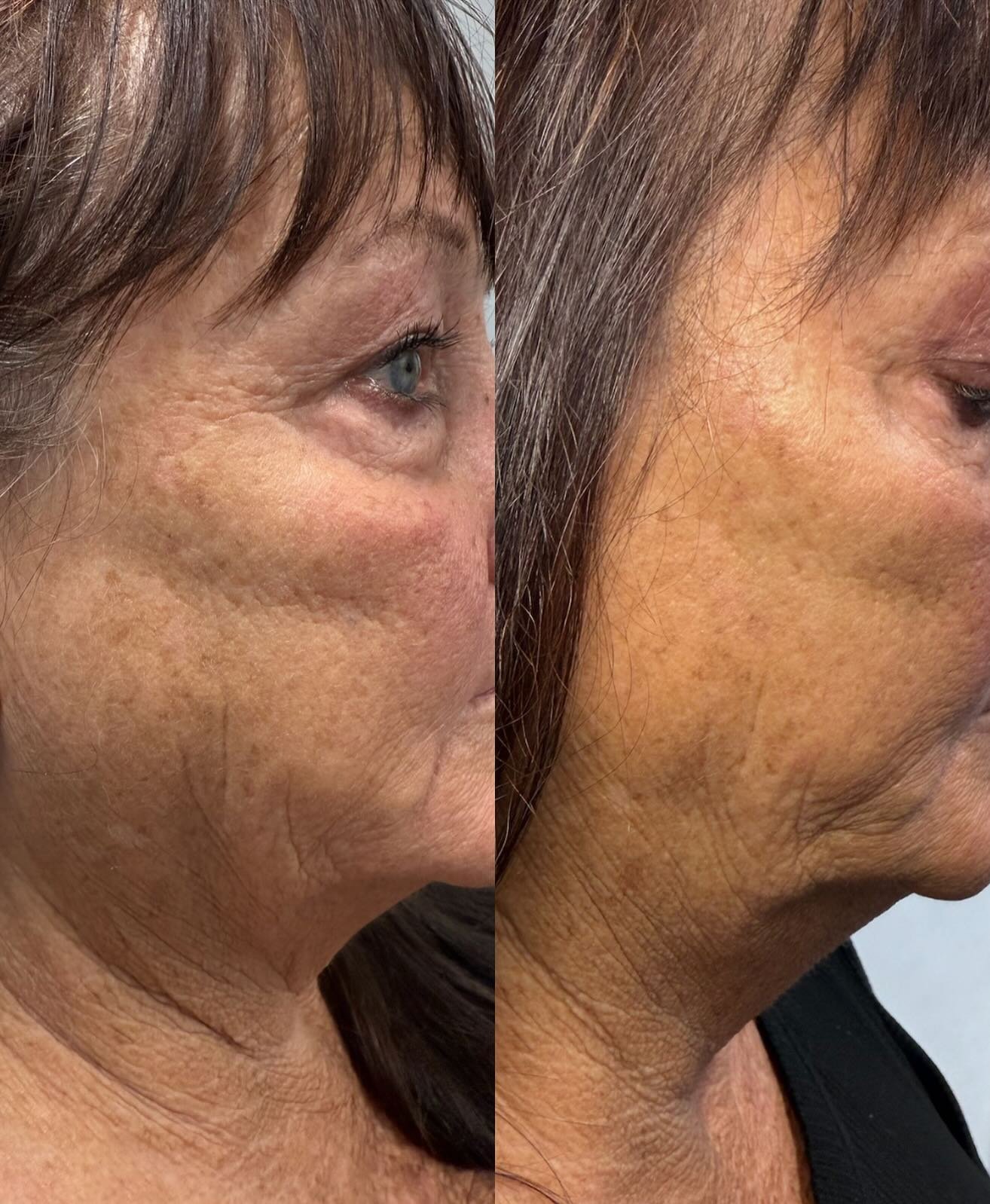 💫 Rebuilding Confidence After Trauma &ndash; Before &amp; After Radiesse 💫
This remarkable transformation tells a story of strength, healing, and artistry. After a serious car accident, our beautiful client came to us for facial reconstruction&mdas