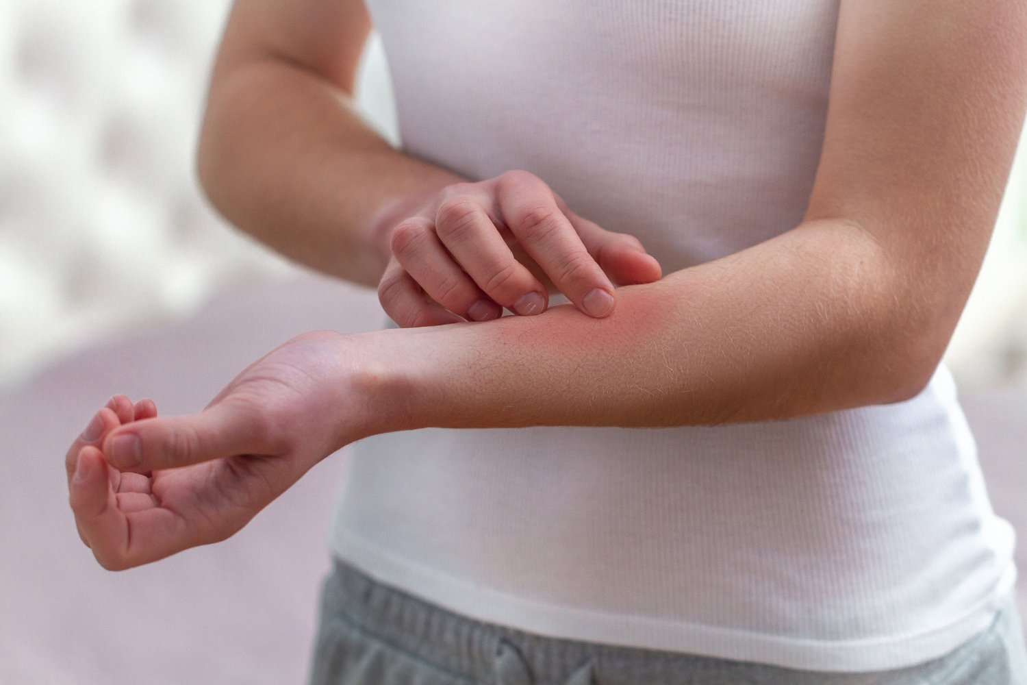 What Legal Advice Matters Most if Bitten by Bed Bugs