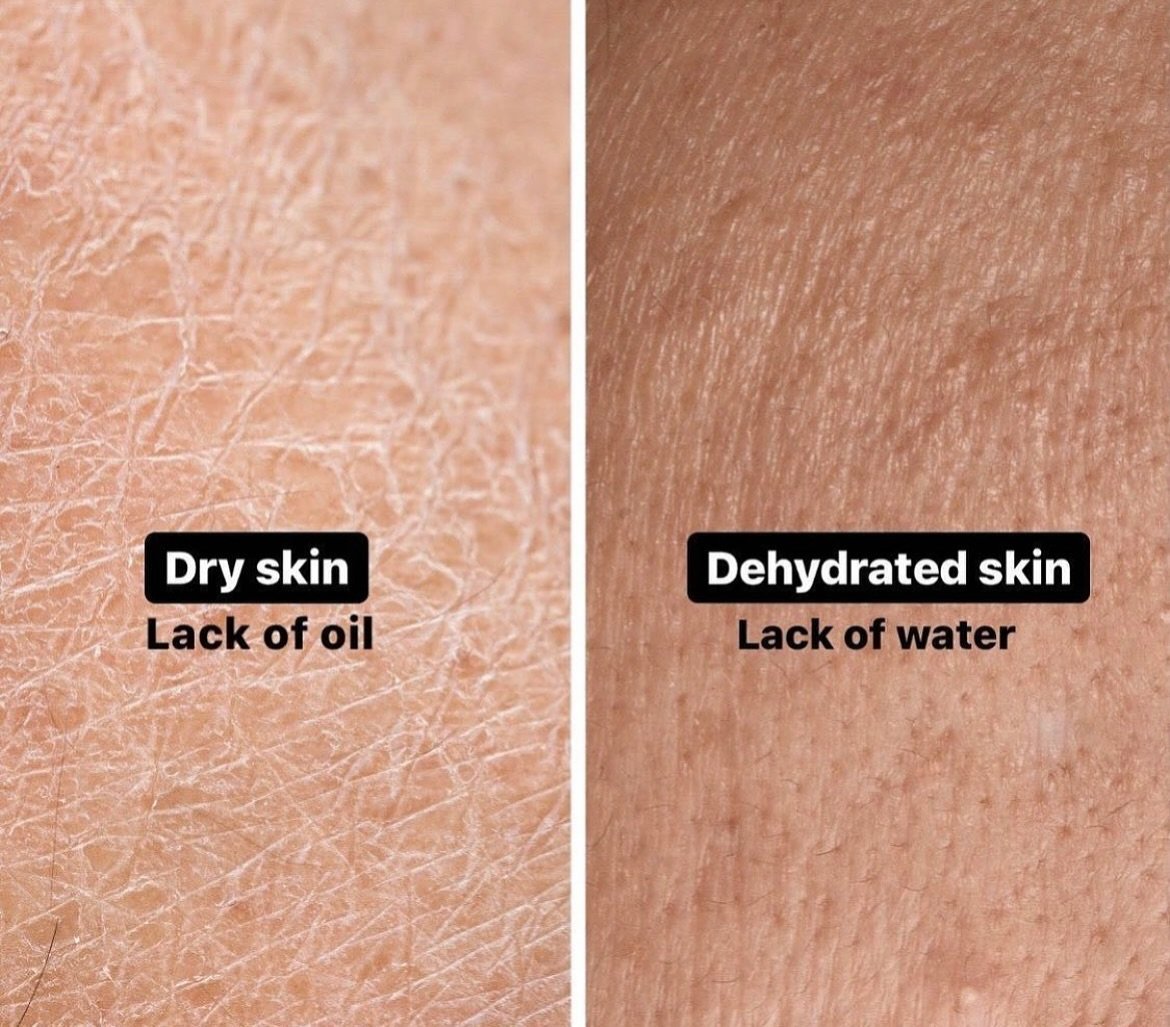Feel like your products just aren&rsquo;t cutting it for your dry skin? 😩 You might be using the wrong ones &mdash; or skipping exfoliation (yep, it matters!) Let us help you figure out what your skin actually needs 💧💧💧

#skin #dryskin #santacruz