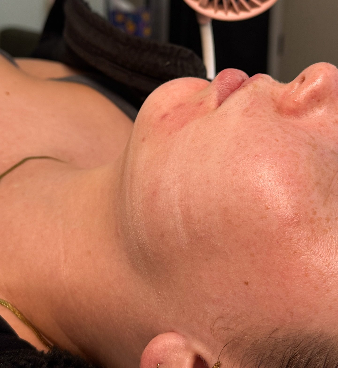 No snow in Santa Cruz ❄️ but our skin still frosts ✨
That icy white look = the peel bonding with skin proteins and getting to work.
Grey skies, new skin incoming 🤍

#skincare #chemicalpeel #santacruz