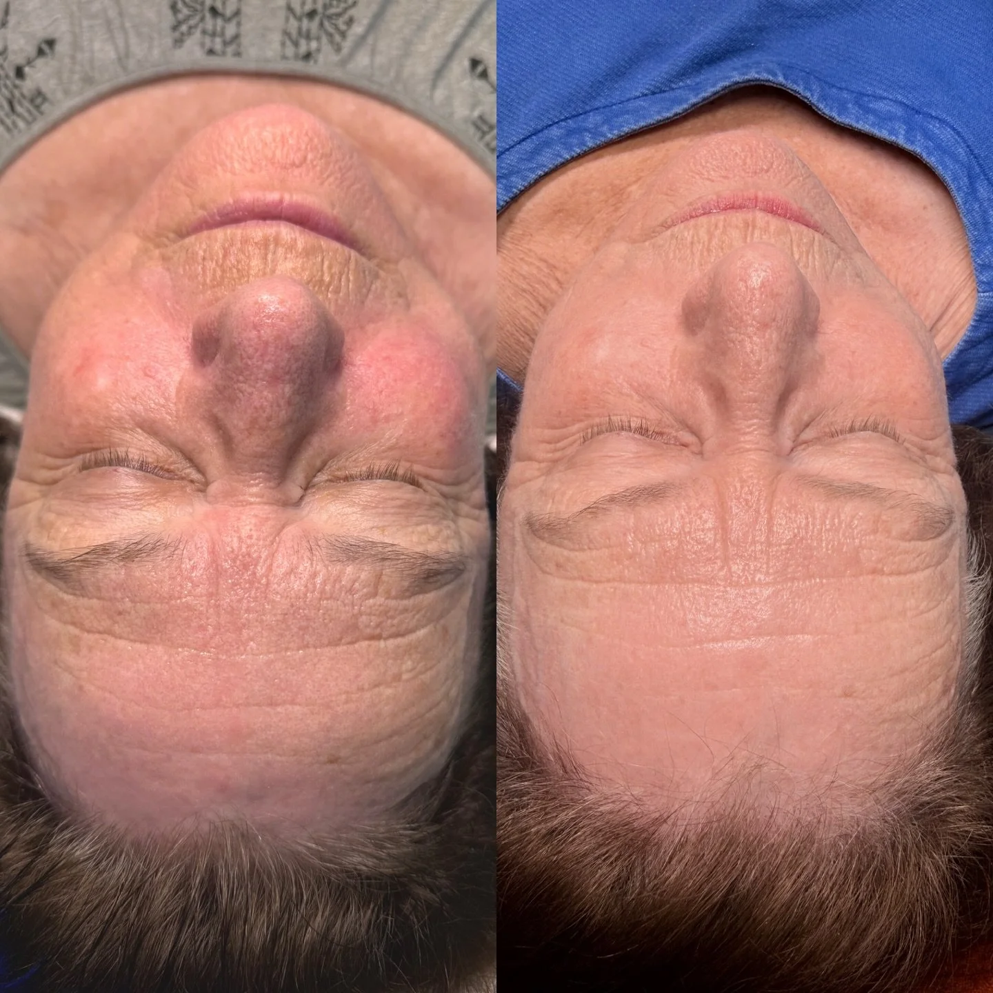 After two spicule-based treatments (deep sea peel) &rarr; smoother texture, clearer tone, healthier skin function.

Why we love them:
&bull; stimulate from within (not just surface exfoliation)
&bull; safe year-round
&bull; build results over time

W