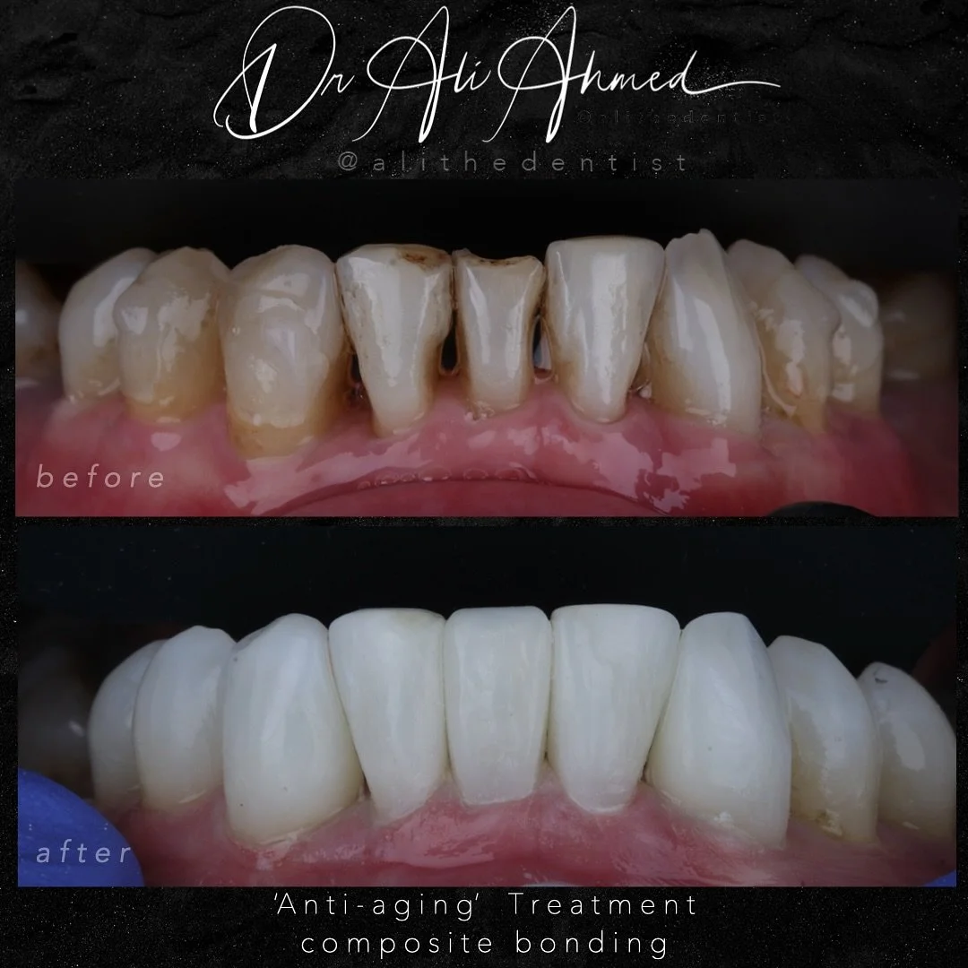 ✨ Just like our hands can give away our age, our lower teeth can give away an aging smile.

As dentists, we often prioritise upper anterior aesthetics in smile makeovers, but the lower teeth can dramatically impact how youthful (or aged) a smile appe