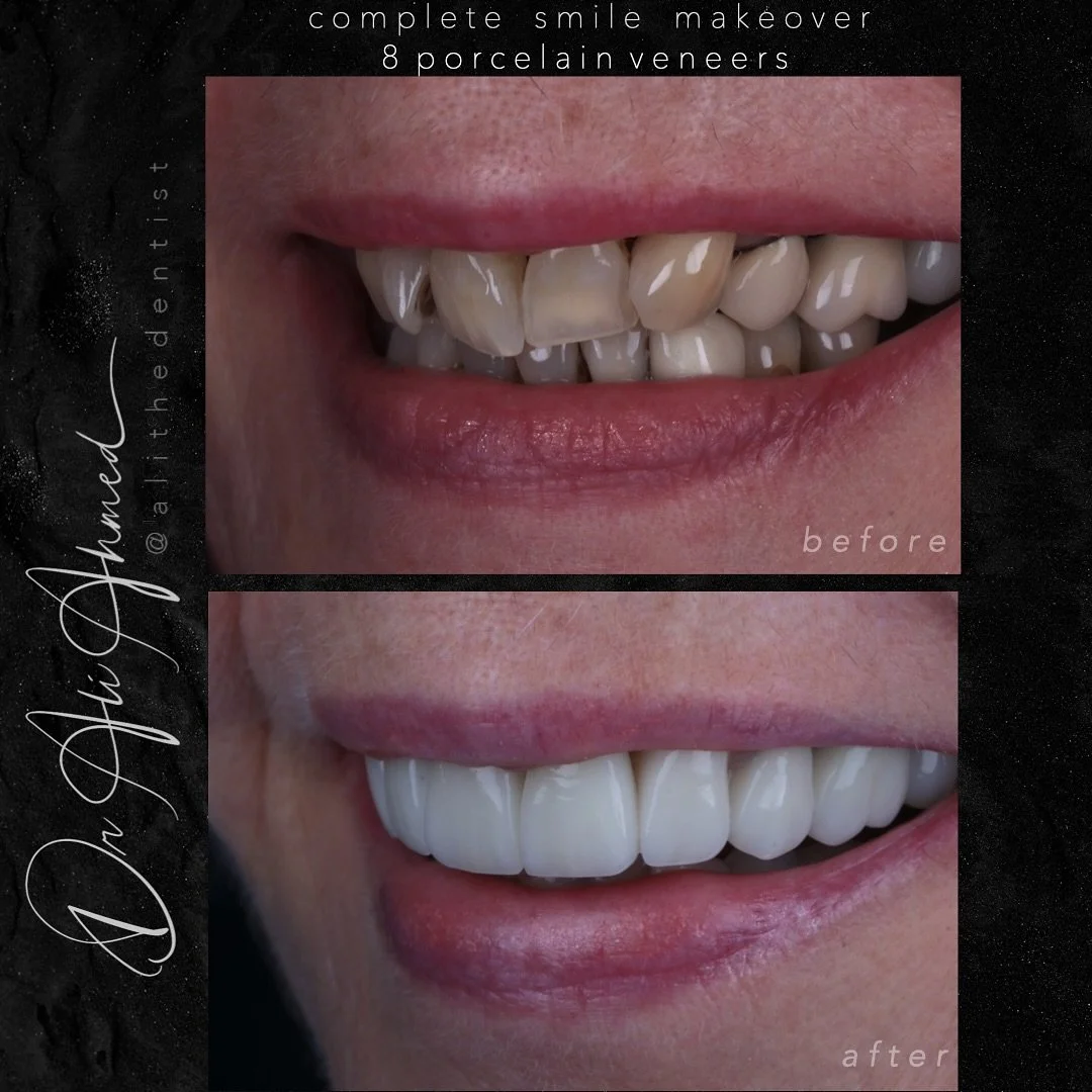 This one was worth the wait 🙌

Back with a beautiful case that really meant a lot &mdash; both to me and my patient.

She&rsquo;d been self-conscious about her front teeth for as long as she could remember, but never felt ready to make a change. Aft