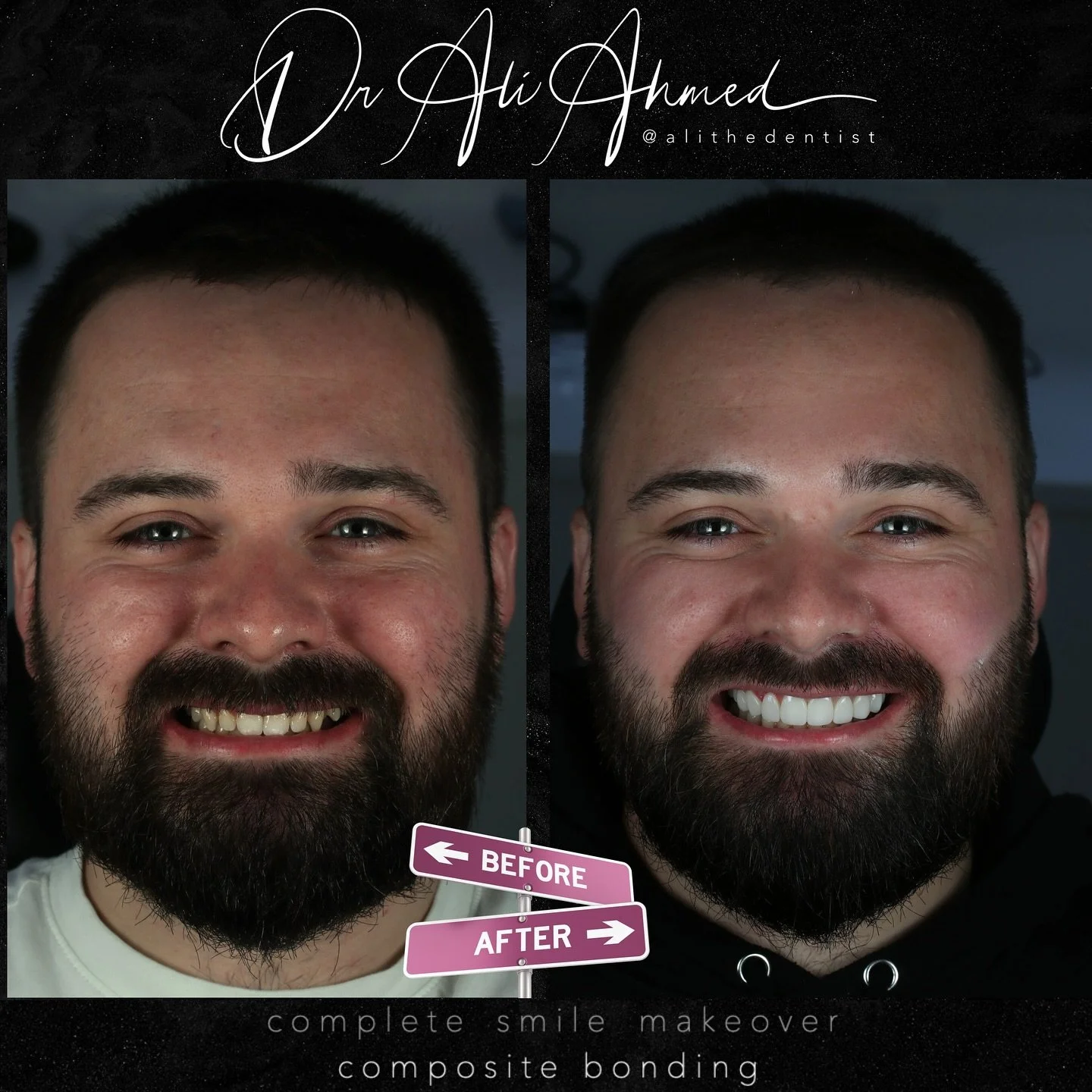 ❄️THE FULL TEN❄️

Smile makeover using composite bonding for the Upper 10 teeth 

A result like this comes from more than just technique &mdash; it&rsquo;s about understanding what the patient envisions, even when they can&rsquo;t fully explain it, a