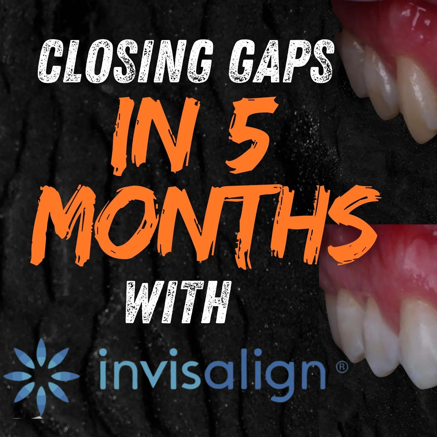 When it comes to closing gaps in a smile, there&rsquo;s no one-size-fits-all solution &mdash; only the right solution for the patient in front of you.
ㅤ
This patient came to me wanting to close the spaces between their teeth, improve symmetry, and ga