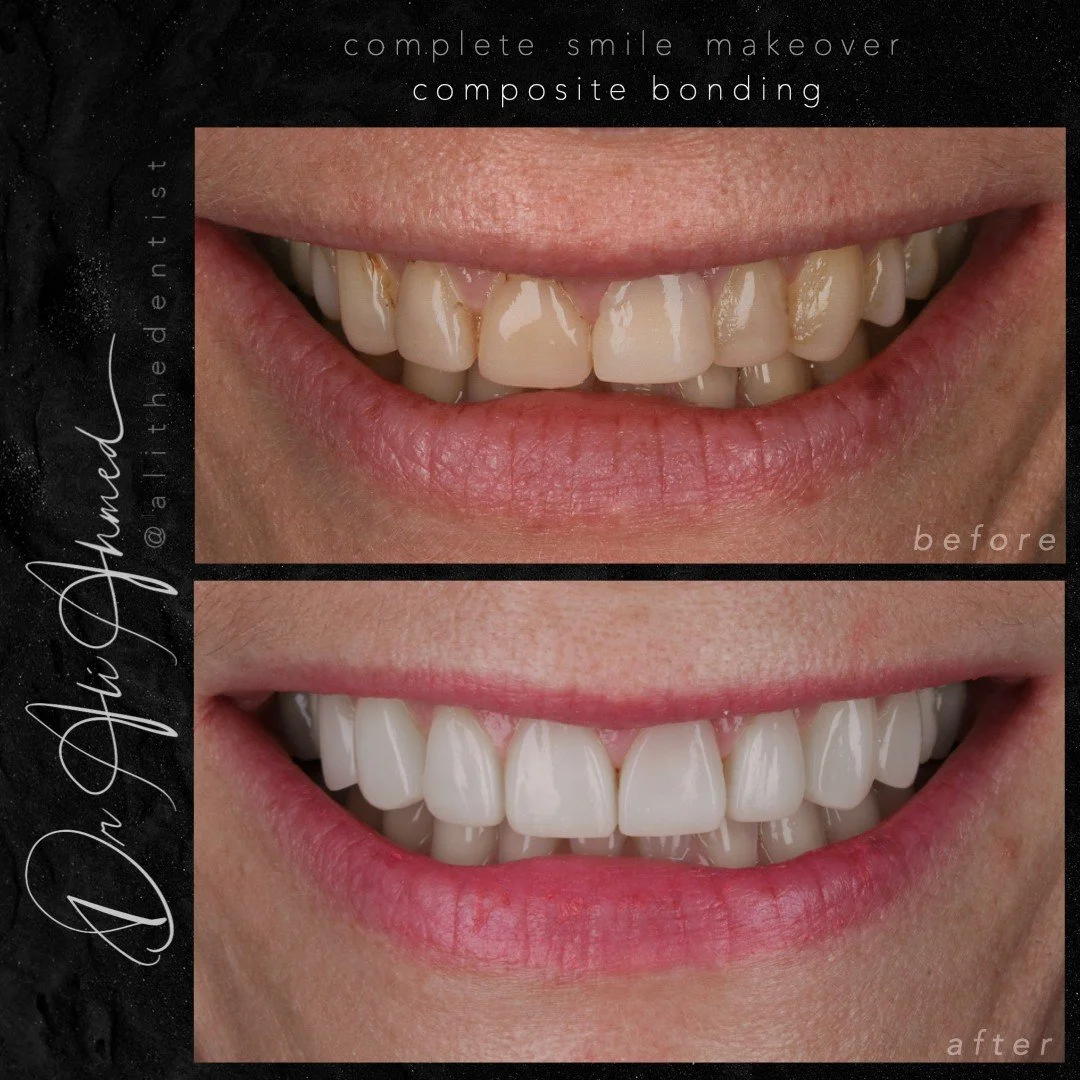 ✨ NOT all composite bonding is the same&hellip; ✨
This case was a corrective one &mdash; and I&rsquo;m so proud of the result 💪🏼
ㅤ
My patient came in with old, poorly placed composite veneers 😬
❌ Inflamed gums
❌ Stained edges
❌ Flat, fake-looking 