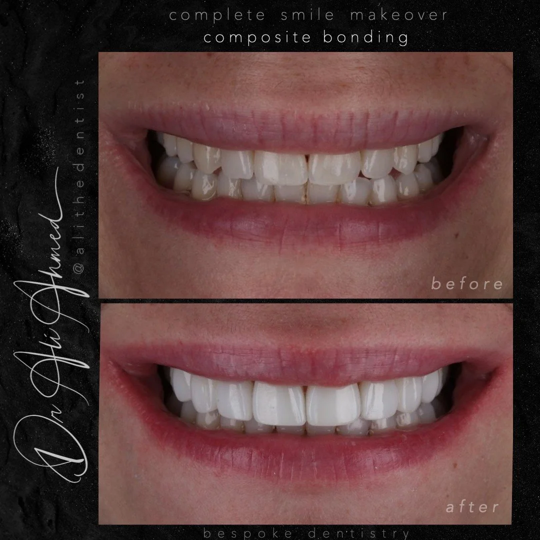 📍The One Where She Keeps Her Character, But Levels Up 🚀
ㅤ
This smile transformation was all about subtle enhancements&mdash;using composite bonding to refine the front 8 teeth while keeping the patient&rsquo;s natural shape and character. The goal?