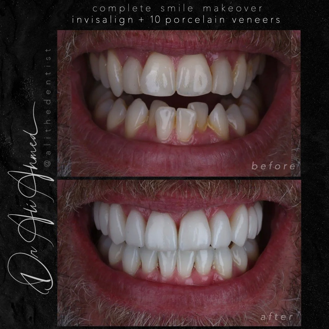 Who doesn&rsquo;t love a big smile? It&rsquo;s contagious! 😁✨
ㅤ
10 upper veneers after Invisalign&mdash;because the best enhancements start with a strong foundation. #SmileGlowUp #Veneers #Invisalign #SmileTransformation