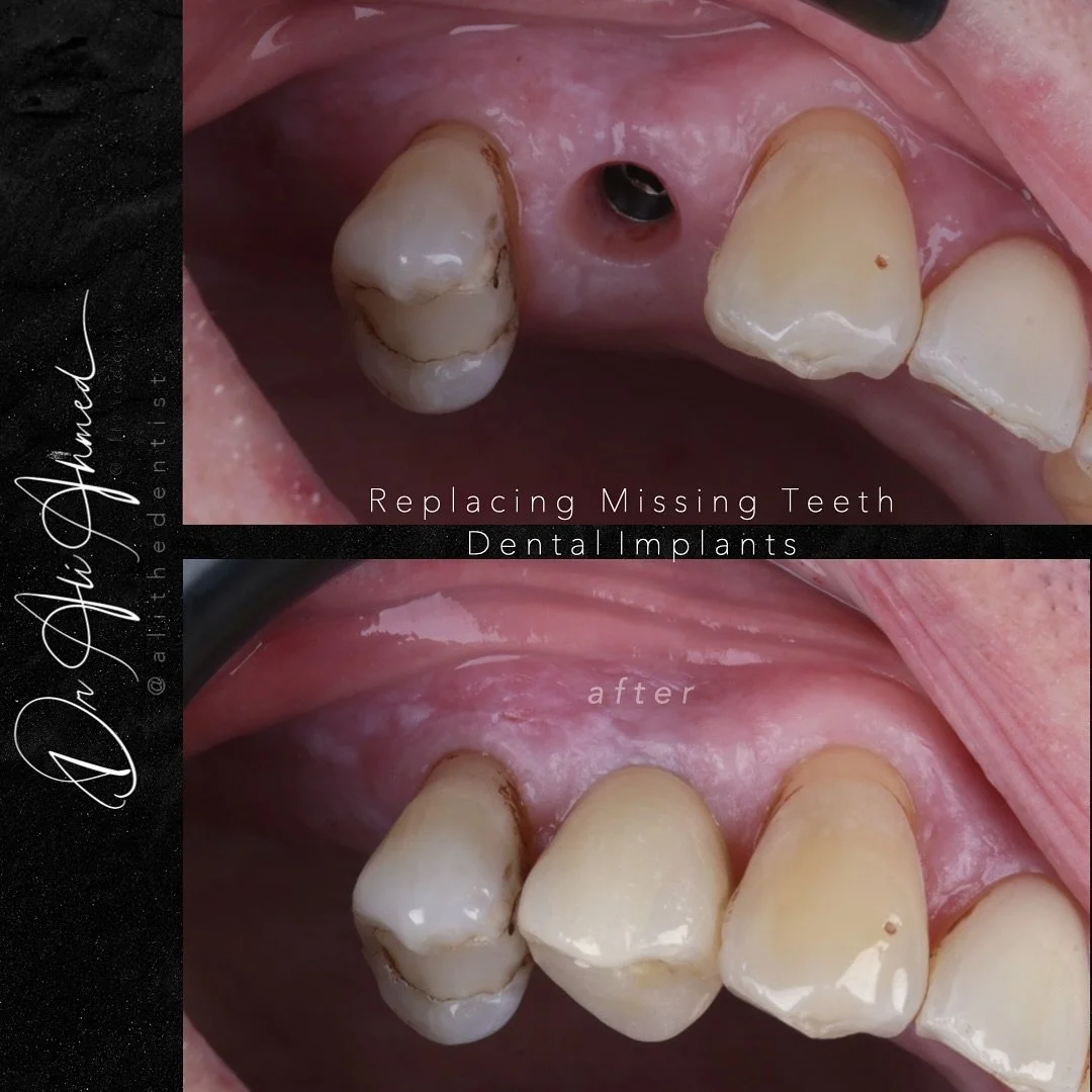 Eat what you love. Feel like yourself. Smile without holding back.
Dental implants bring your confidence &mdash; and comfort &mdash; back.
A smile so complete, only you and God know what&rsquo;s real. 🦷💫