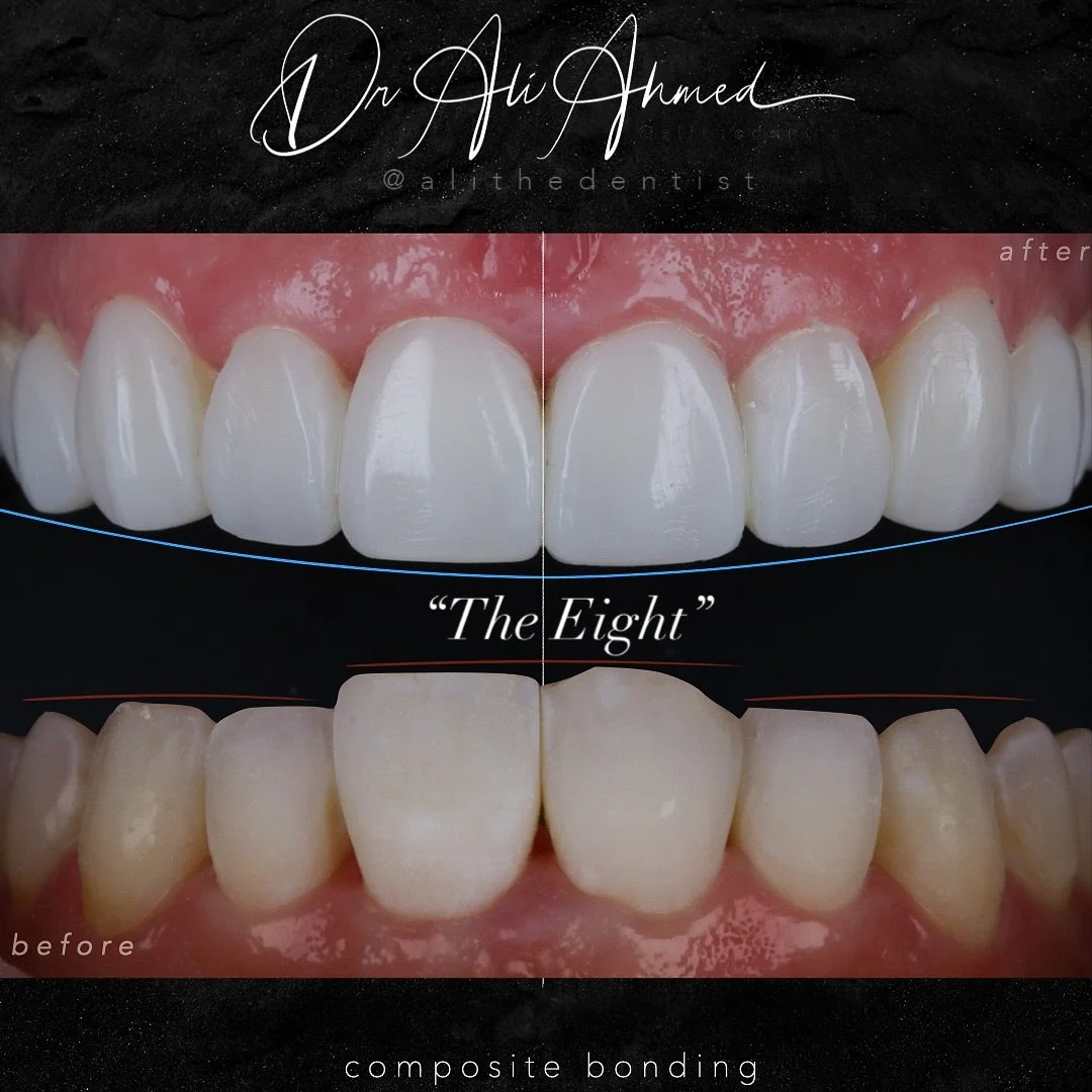 ✨ The Eight ✨

8 teeth transformed.
8 reasons to say yes to composite bonding 👇

1️⃣ Minimally Invasive &ndash; usually no drilling, no injections.
2️⃣ Same-Day Results &ndash; walk in and walk out with a new smile.
3️⃣ Natural Finish &ndash; blends