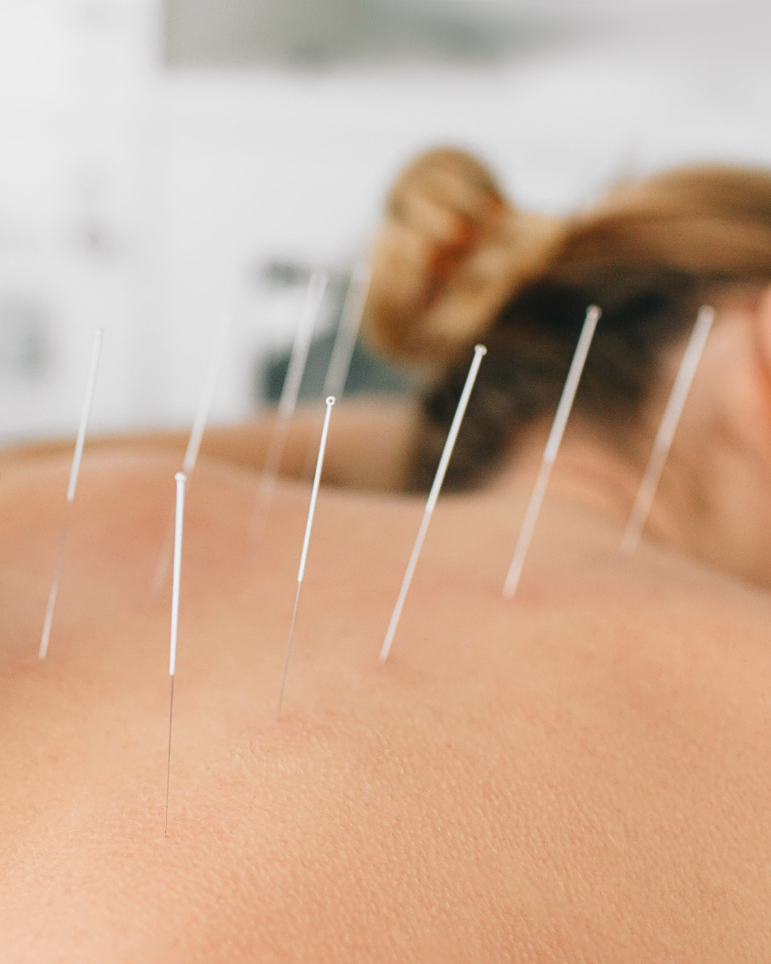 Acupuncture treatment with multiple needles inserted into a woman's back.