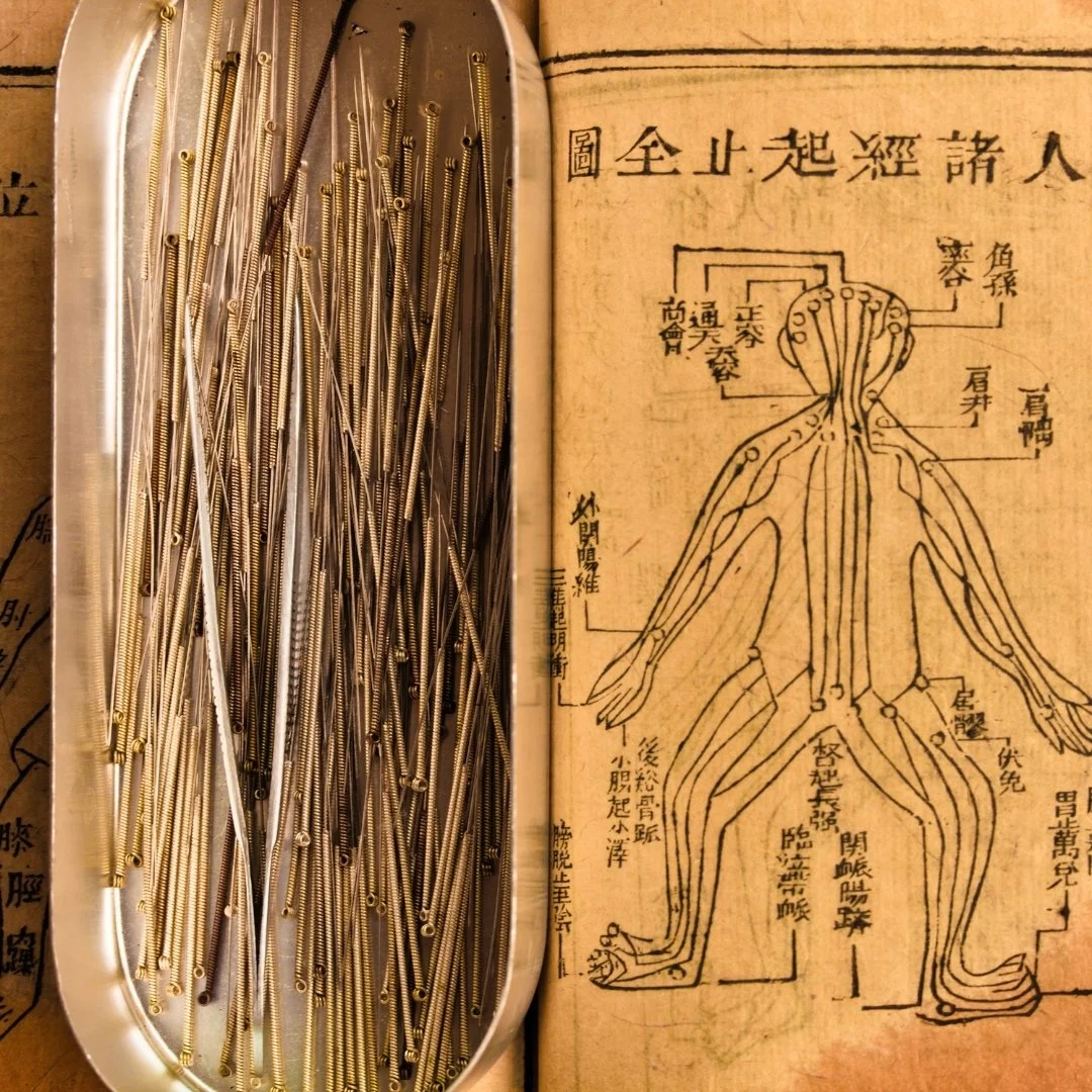 Metal acupuncture needles placed in a metal container on an open traditional Chinese medical book showing acupuncture points on a human figure.