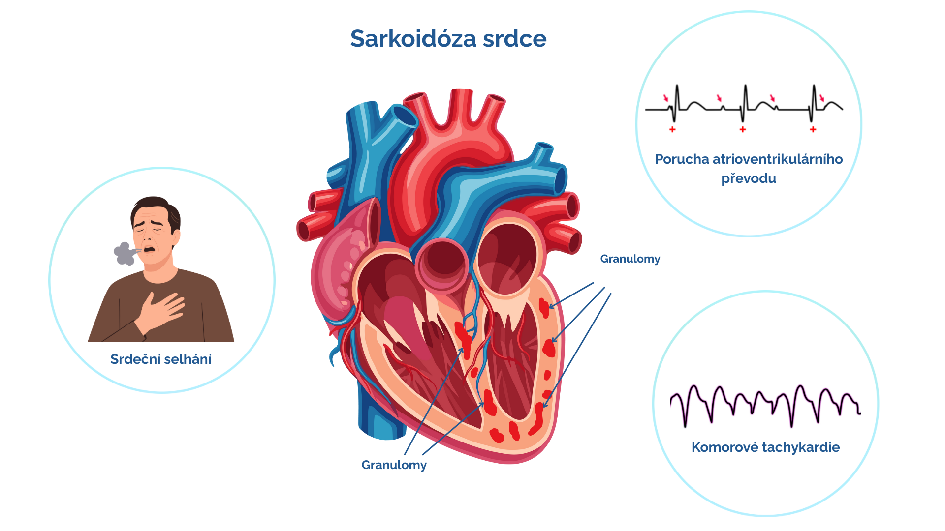 Schematické znázornění srdeční sarkoidózy a jejích nejčastějších projevů. Zánětlivé oblasti obsahující mikroskopické granulomy jsou přítomny v levé srdeční komoře a mezikomorovém septu.
