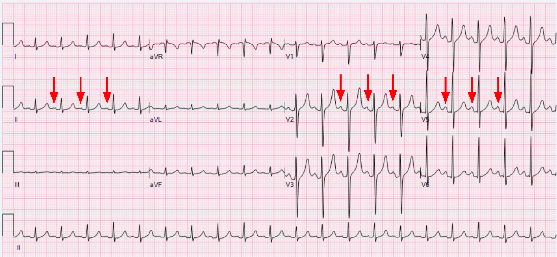 Sinus tachycardia - a natural, but accelerated rhythm. Arrows indicate contractions of the atria, which precede contractions of ventricles. The heart rate is higher than 100/min in tachycardia.