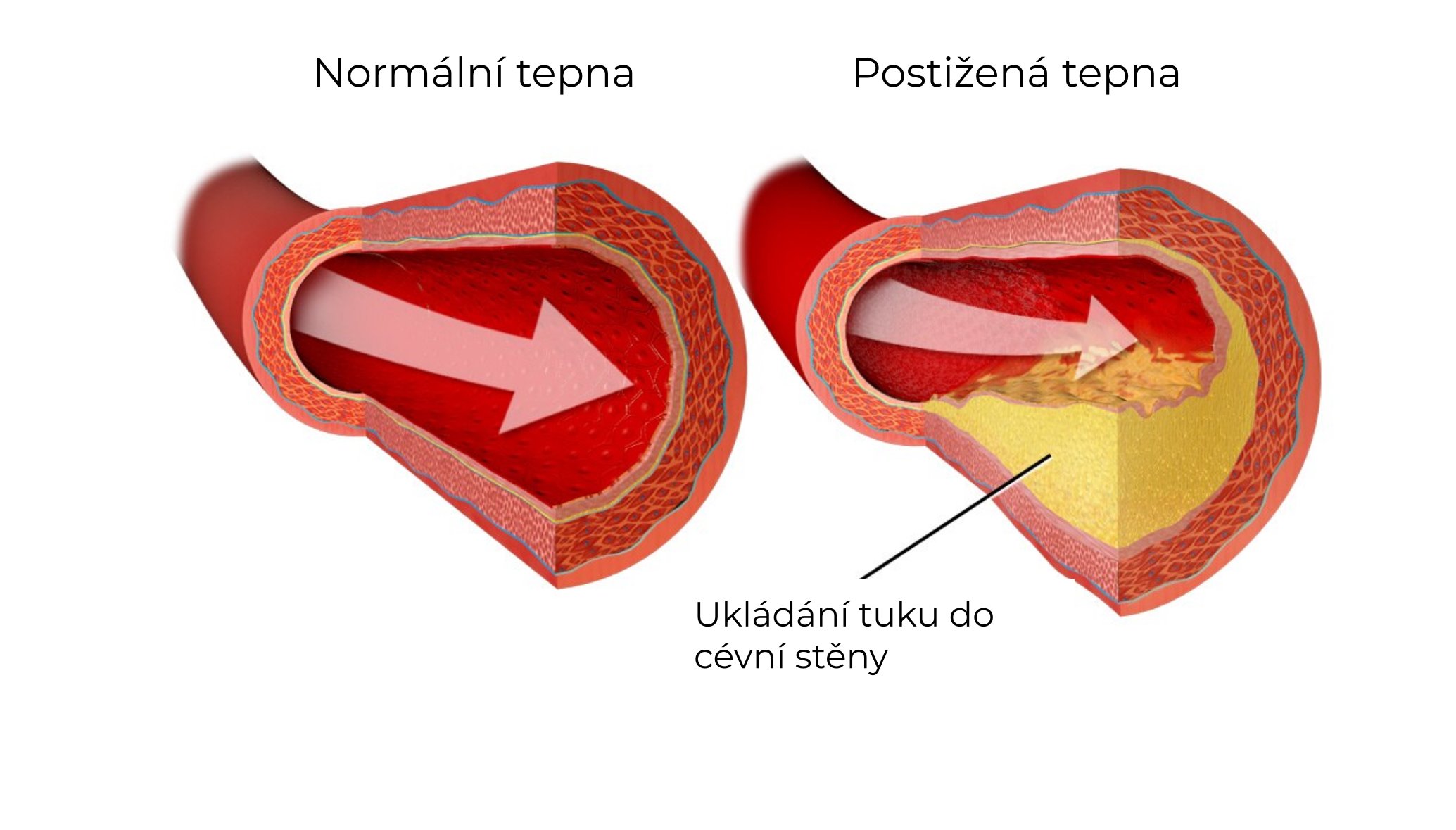 Aterosklerotický plát bohatý na lipidy
