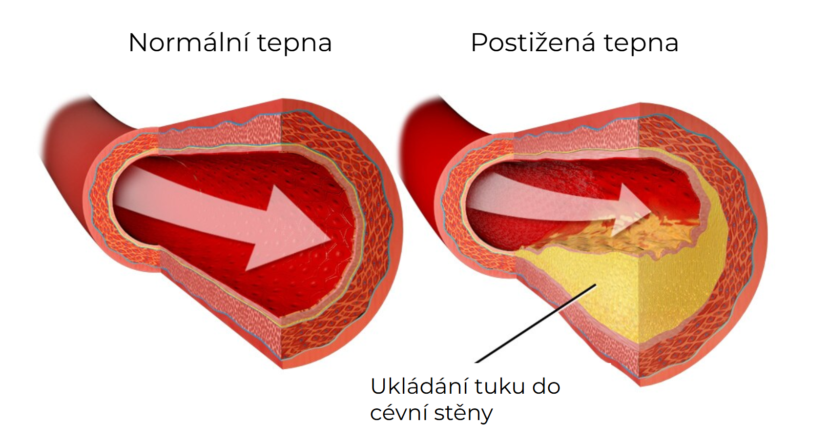 Ateroskleroza - srovnání zdravé a postižené tepny