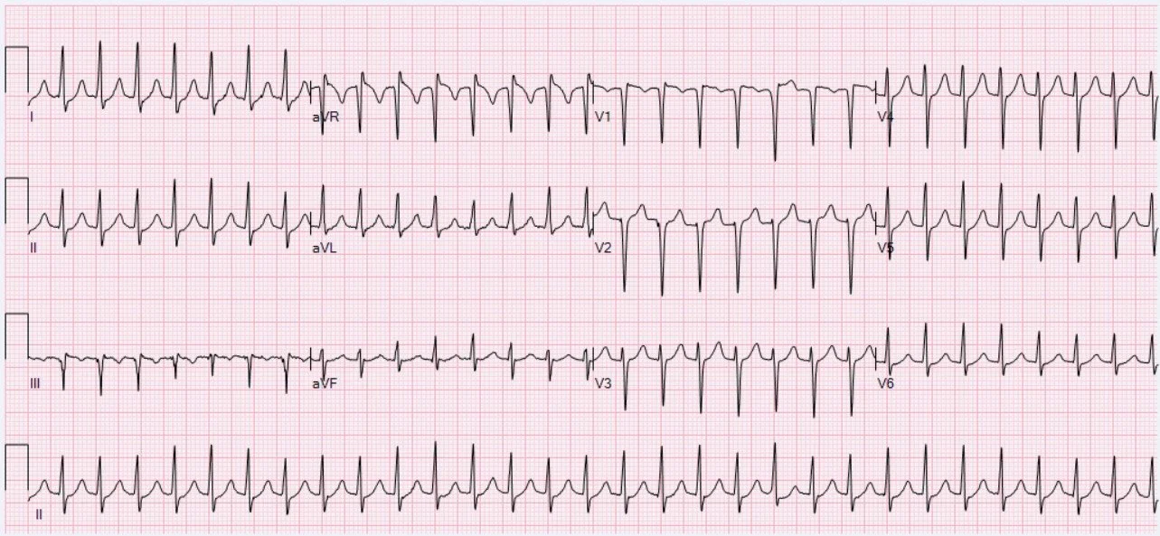 ECG image of AV nodal reentry tachycardia, the heart impulse circles in a nodule between the atria and ventricles. Thus, the atria and ventricles contract simultaneously. Unlike sinus tachycardia, atrial contractions are not apparent on the curve because they are superimposed on the contractions of ventricles.